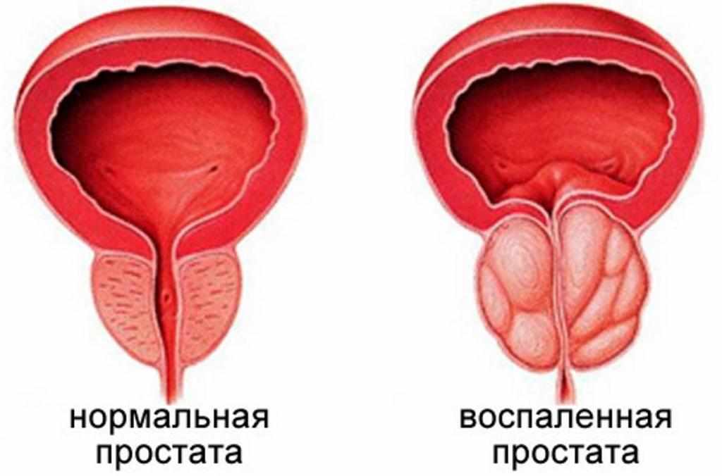 Это простата